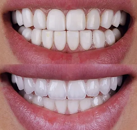 Αντικατάσταση παλαιών όψεων σύνθετης ρητίνης με όψεις πορσελάνης