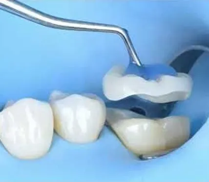 Επένθετο:φτιάχνεται στο οδοντοτεχνικό εργαστήριο και έπειτα σε 2η συνεδρία συγκολλαται στο πάνω μέρος του δοντιού που μας λείπει