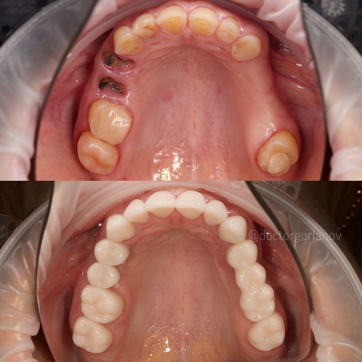 Μονές Στεφάνες και γέφυρες.