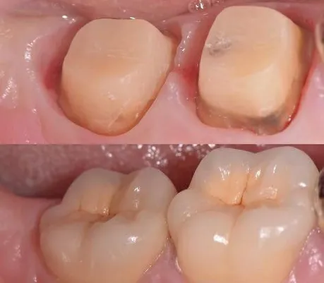 Μονές Στεφάνες (θήκες)