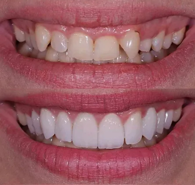 Όψεις πορσελάνης