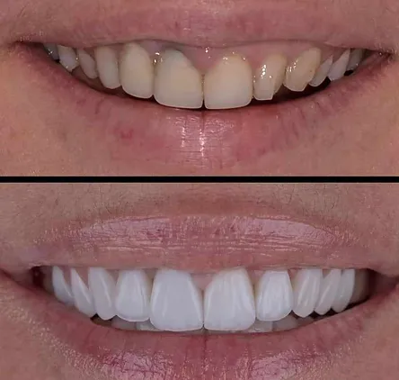 Όψεις σύνθετης ρητίνης